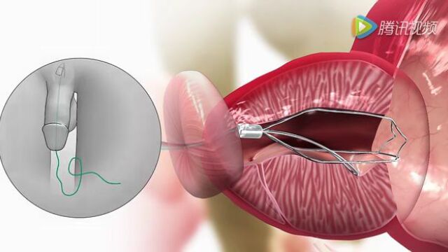 奥林巴斯微创前列腺器械,有临床新进展