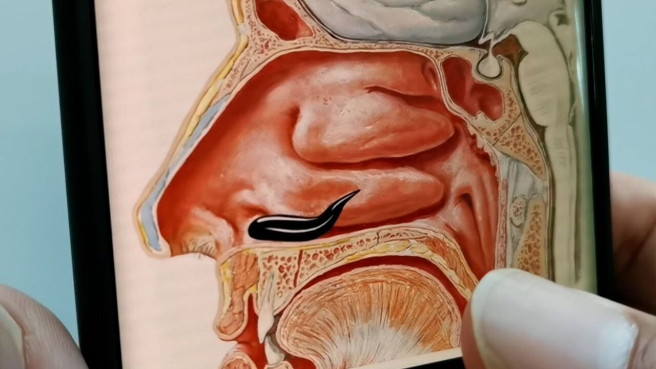 3岁男童不时流鼻血,医生检查后竟发现蚂蟥在其鼻内