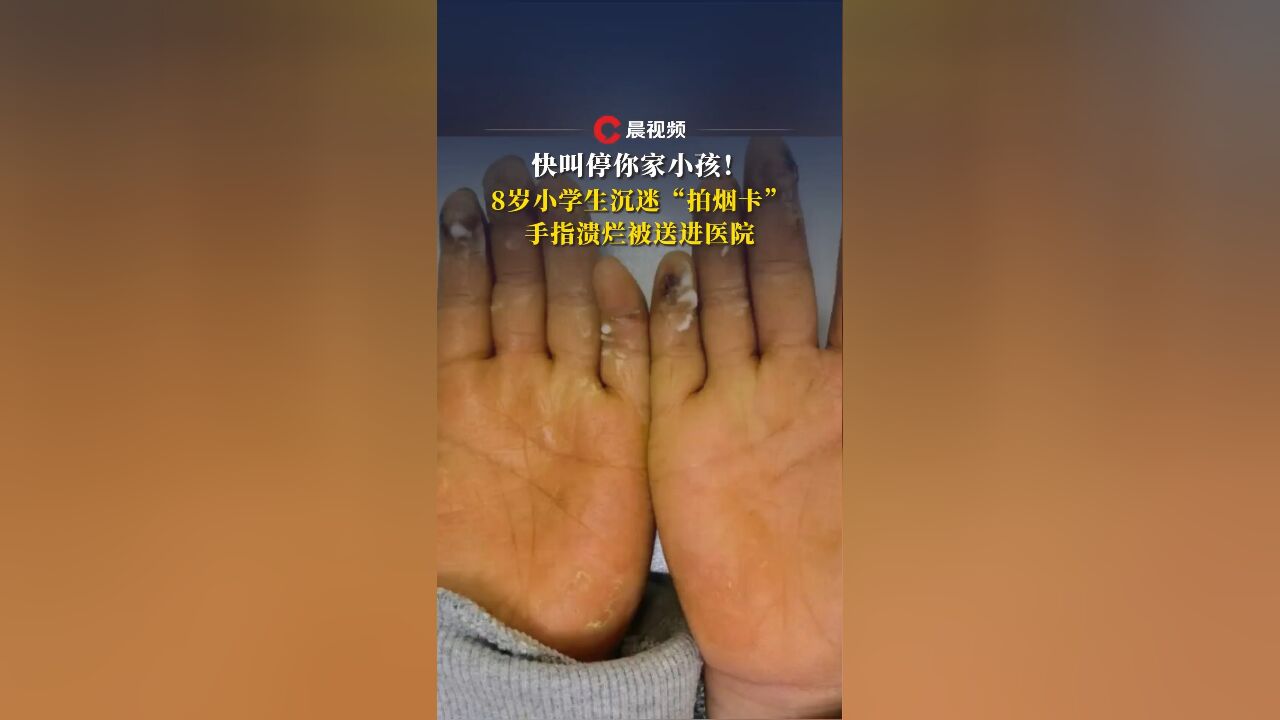 快叫停你家小孩!8岁小学生沉迷“拍烟卡”,手指溃烂被送进医院