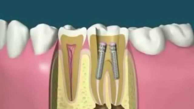 根管治疗打桩做牙冠,一个全面的 治疗过程!