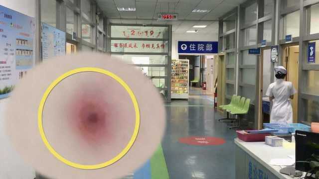 女子被小虫叮咬致多器官衰竭,确诊为恙虫病:被咬时不痛不痒