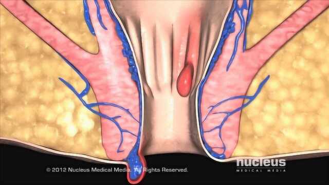 概述痔疮的临床表现及发病诱因