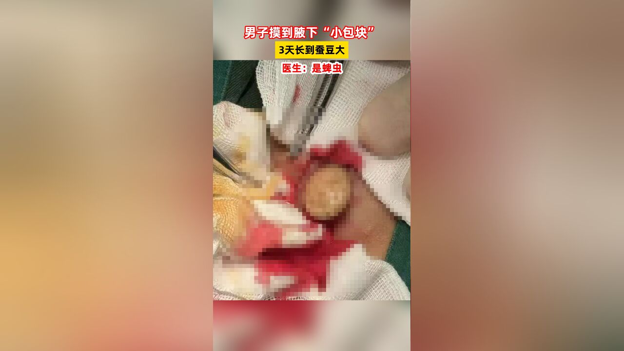 男子摸到腋下“小包块”,3天长到蚕豆大,医生:是蜱虫