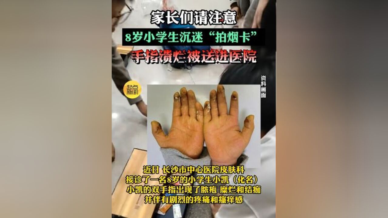 家长们请注意!8岁小学生沉迷拍烟卡,手指溃烂被送进医院