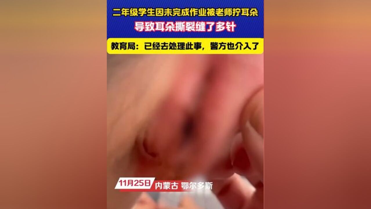 小学生未完成作业被老师拧耳朵致撕裂 #看着就疼