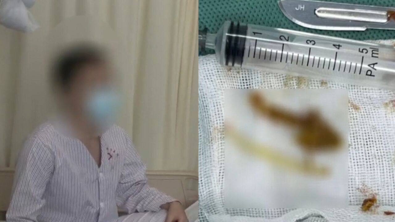 男子吃鱼被卡吞饭解决,第2天肛门巨痛险晕厥,4公分鱼刺直插直肠肛门