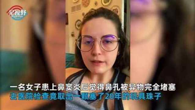 女孩鼻腔“藏珠”20年,手术取出已“包浆”,不忍丢弃做手串佩戴