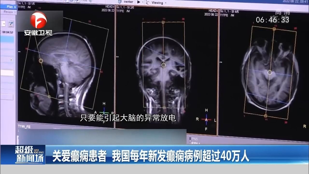 关爱癫痫患者,我国每年新发癫痫病例超过40万人