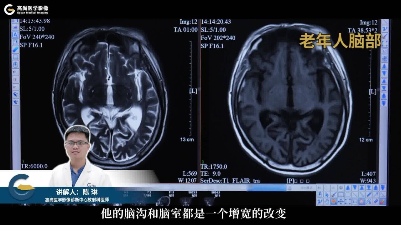 放射科病例分析课:老年性病变——老年人老龄化与脑部退化的表现