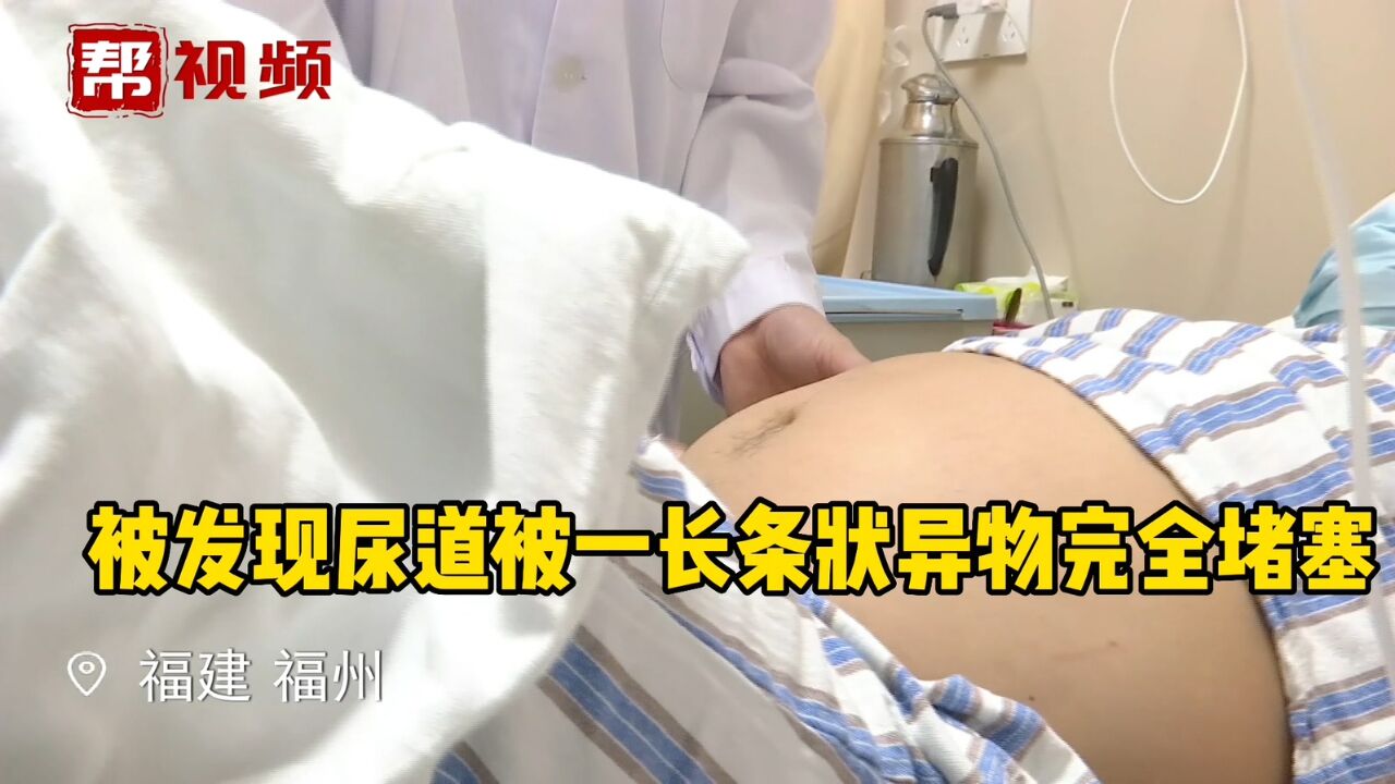 男子膀胱险破裂 医生:20厘米异物堵塞尿道