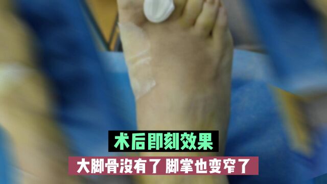 北京哪家医院治疗拇外翻大脚骨比较好