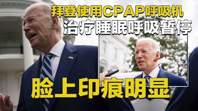 拜登使用CPAP呼吸机治疗睡眠呼吸暂停,脸上印痕明显