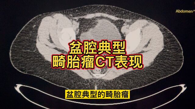 盆腔典型畸胎瘤CT表现