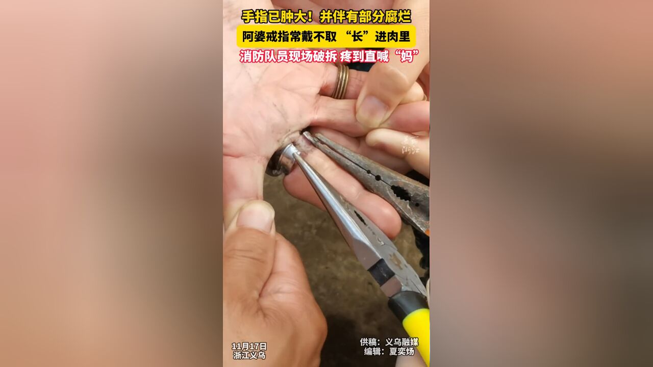 看着就疼!义乌阿婆手上戒指嵌入肉里,消防小哥哥细心破拆