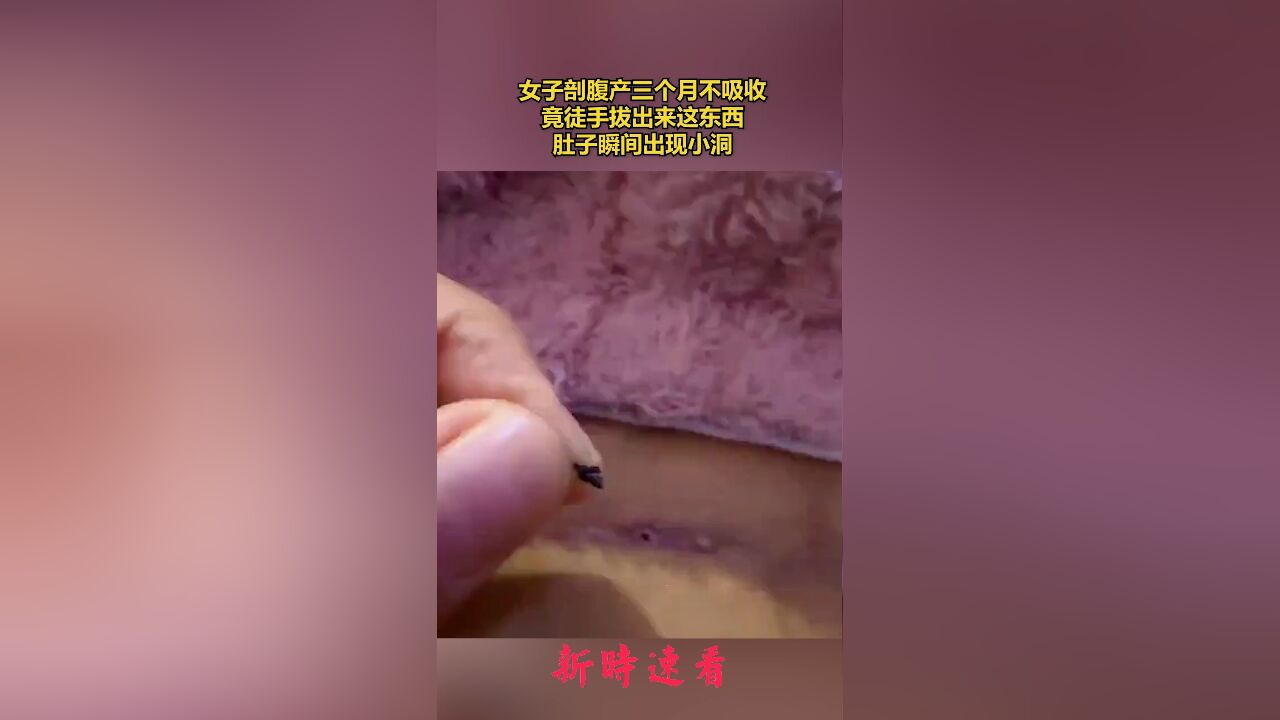 女子剖腹产三个月不吸收,竟徒手拔出来这东西,肚子瞬间出现小洞.