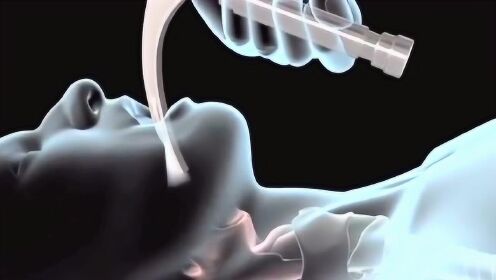 3D科普气管插管如何操作,辅助管被直接插进体内,看着都觉得恐怖! - 腾讯视频