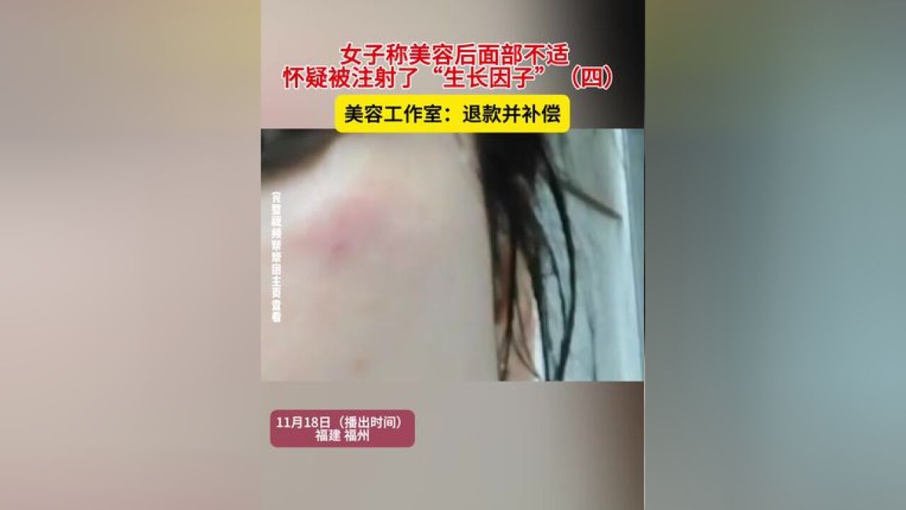 女子称美容后面部不适,怀疑被注射了“生长因子”