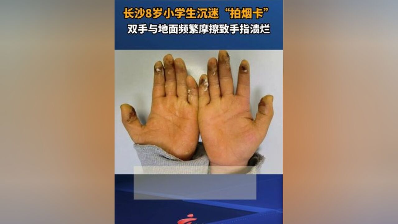 长沙8岁小学生沉迷拍烟卡,双手与地面频繁摩擦致手指溃烂