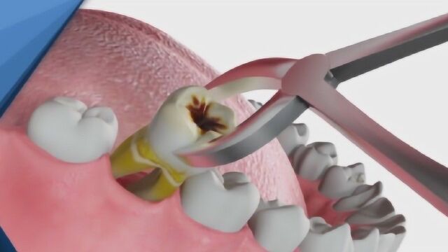 蛀牙拔出瞬间有多疼?镜头直击全过程,隔着屏幕感觉牙疼!
