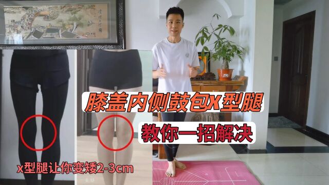 膝盖内侧鼓包?教你1招解决,X型腿不但难看,而且身高变矮23cm