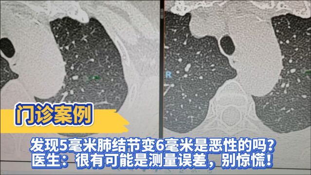 发现5毫米肺结节变6毫米是恶性的吗?医生:很有可能是测量误差,别惊慌!