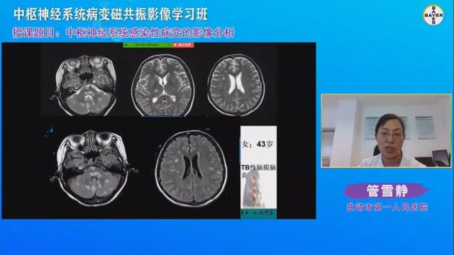 中枢神经系统感染病变的影像分析曲靖市第一人民医院管雪静