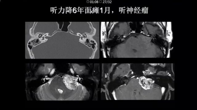 周围性面瘫的影像诊断策略复旦大学附属眼耳鼻喉科医院沙炎