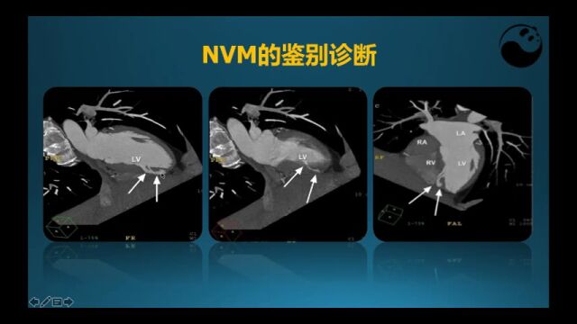 【才俊讲堂】孔令秋:心肌致密化不全(NVM)的鉴别诊断及小结