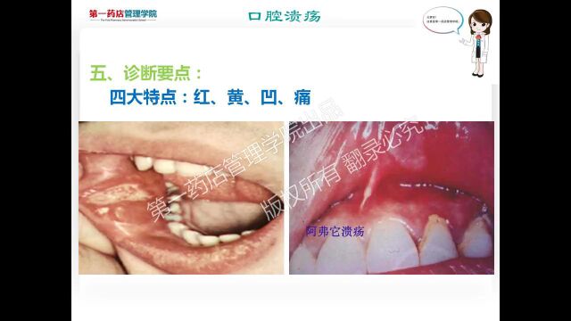 五官科疾病4口腔溃疡