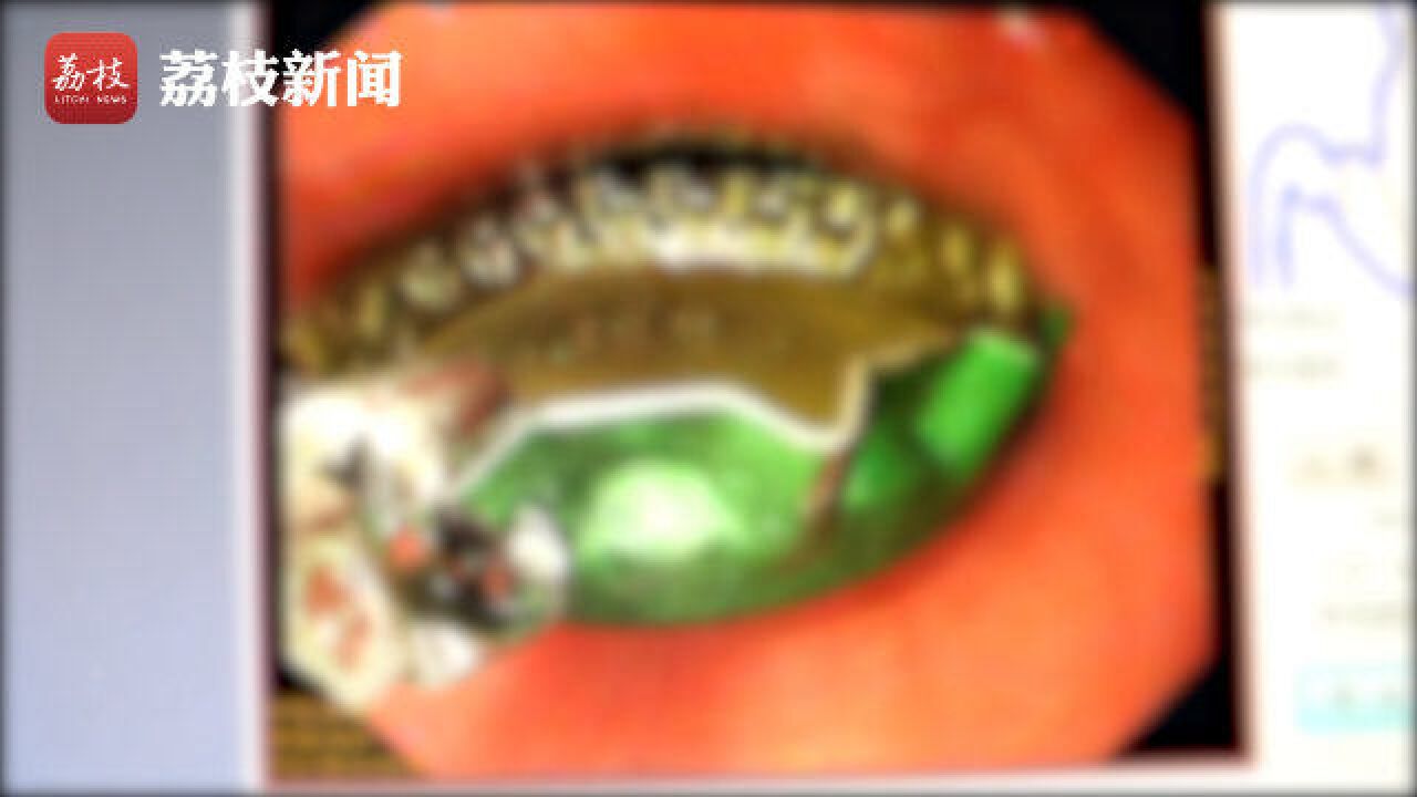 吃惊!男子用馒头咽异物疼痛难忍 内镜取出竟是啤酒瓶盖