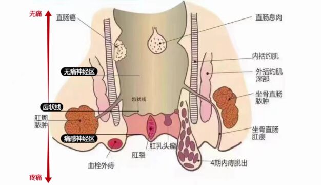 复兴中医肛肠:肛门病有痛与无痛介绍