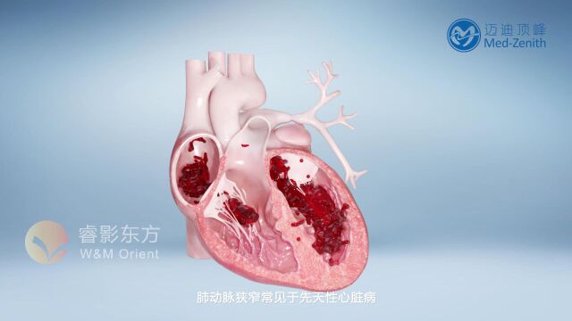 [3D医学动画]三维医学动画演绎肺动脉支架