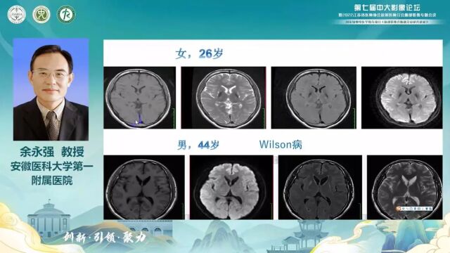 双侧基底节丘脑异常的诊断与鉴别诊断安徽医科大学第一附属医院余永强