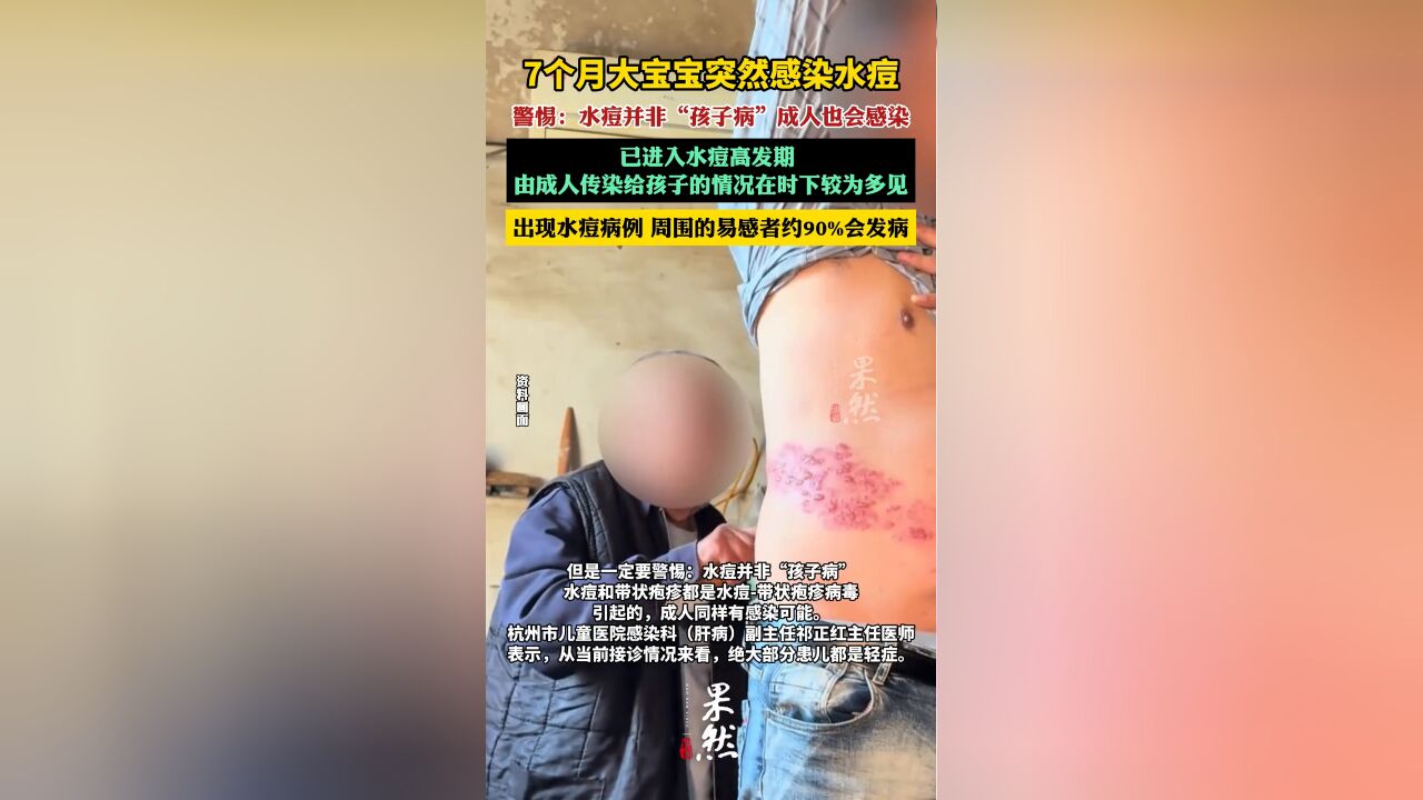 杭州7个月大宝宝突然确诊水痘