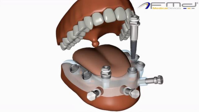 3D演示:漂亮假牙安装全过程,爱美是有风险的
