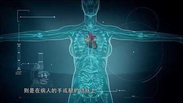 动脉上开个小孔,医生置入微导管,从而疏通病人血管!