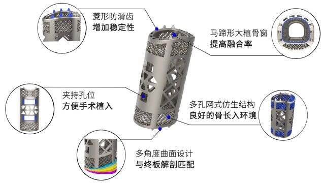 3D打印多孔型椎体融合器