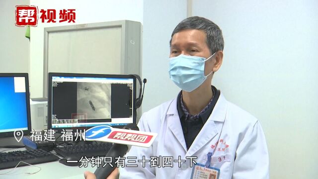 14万元,胶囊大小,男子被植入全球最小心脏起搏器