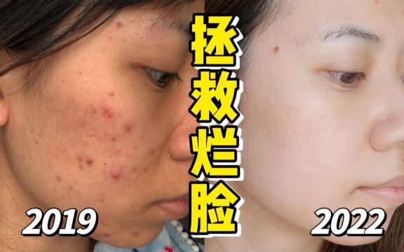 3年抗痘血泪史!从痘肌到牛奶肌经验分享~ 无广|纯干货