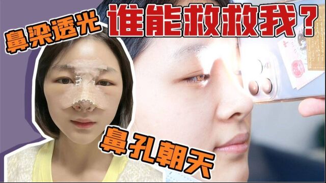 毁了的鼻子还能救吗?花三万做鼻修复值不值?隆鼻50天效果分享