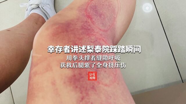 幸存者讲述梨泰院踩踏瞬间:用拳头撑着缝隙呼吸 获救后腿紫了全身挤压伤