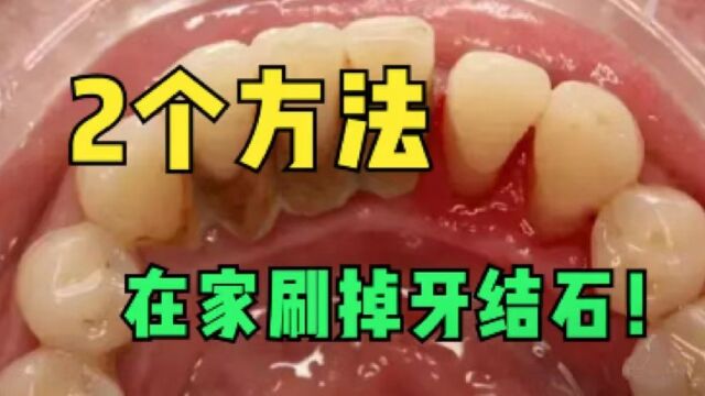 牙缝里长满牙结石?教你这几招,轻松在家清除成片牙石!!