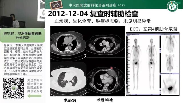 肺空腔、空洞性病变诊断分析思路中大徐秋贞