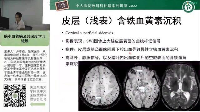 脑小血管病概念、影像维度及其深度学习进展中大卢春强