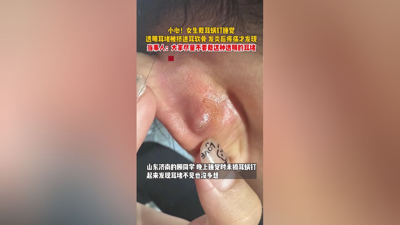 小心!女生戴耳蜗钉睡觉,透明耳堵被挤进耳软骨,发炎后疼痛才发现,当事人:大家尽量不要戴这种透明的耳堵.