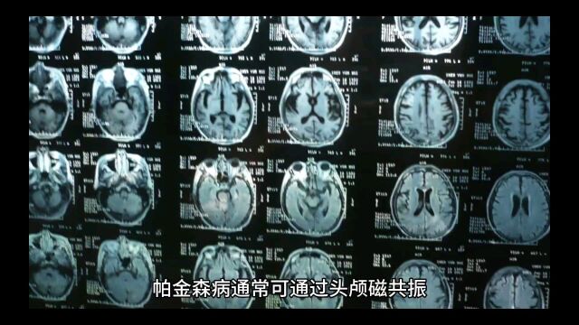 帕金森病通过什么检查才能确定呢?