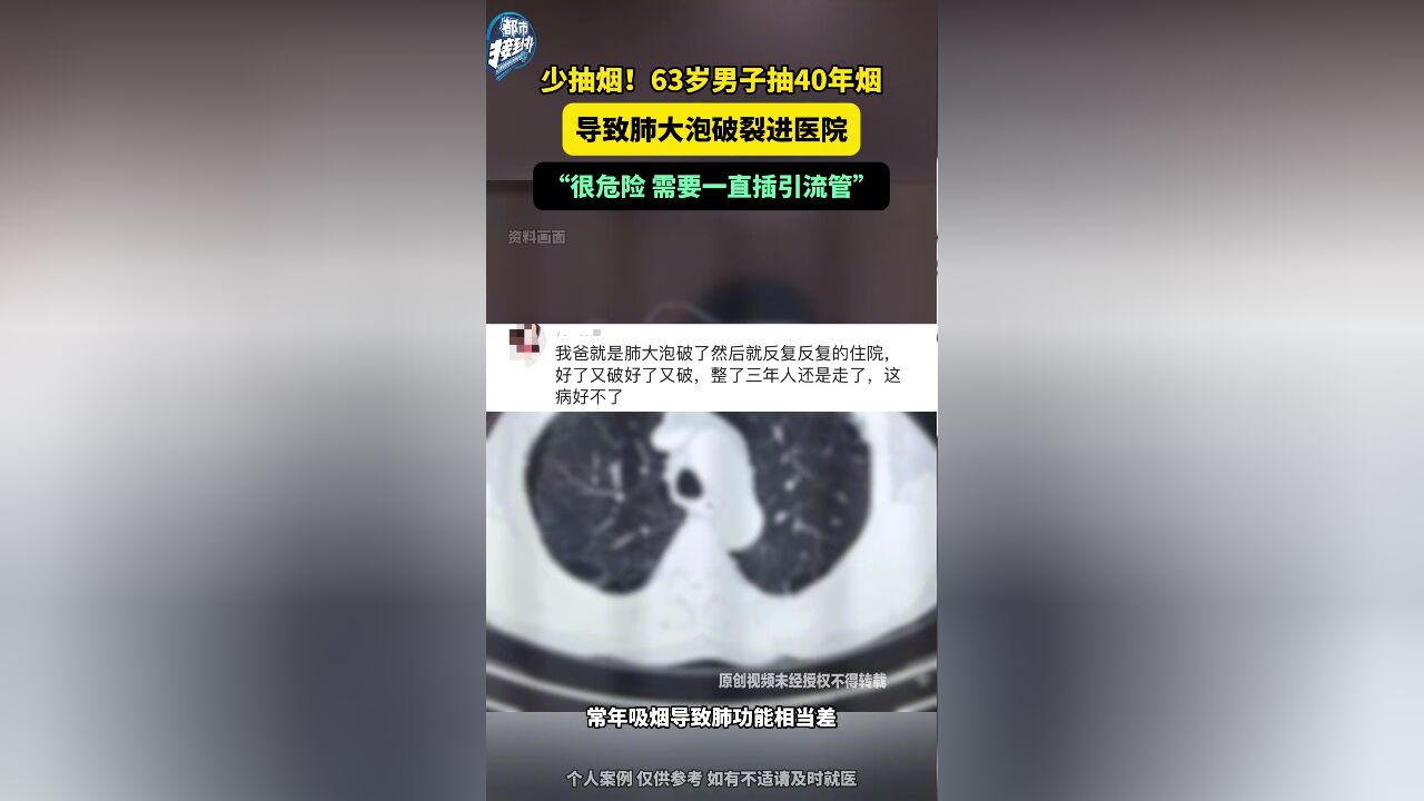 少抽烟!63岁男子抽40年烟 导致肺大泡破裂进医院