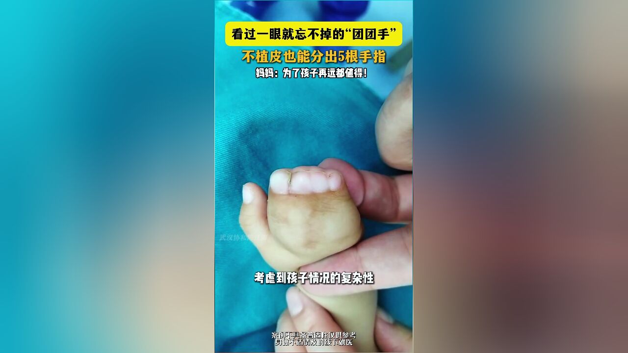 看过一眼就忘不掉的“团团手”,不植皮也能分出5根手指