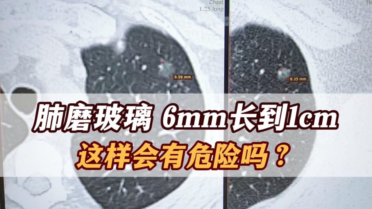 6mm肺磨玻璃结节,7年时间,长到近1cm,是不是很危险?