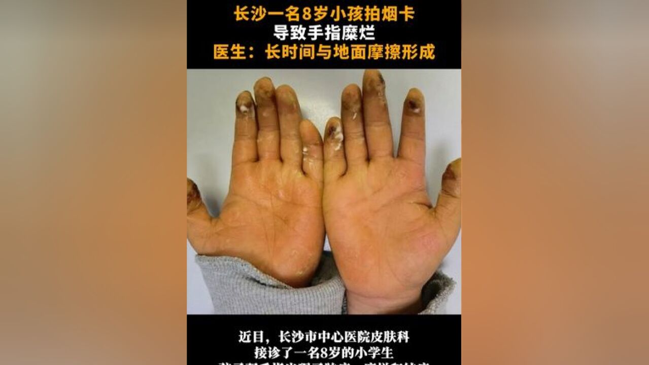 长沙一名8岁小孩拍烟卡导致手指糜烂,医生:长时间与地面摩擦形成